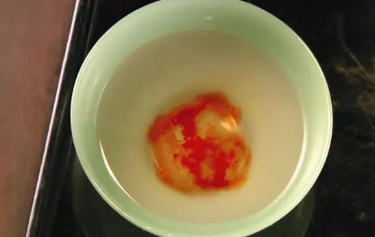 親子鑒定檢驗血型血痕，被鑒定人應了解自己或近親屬有無遺傳病史